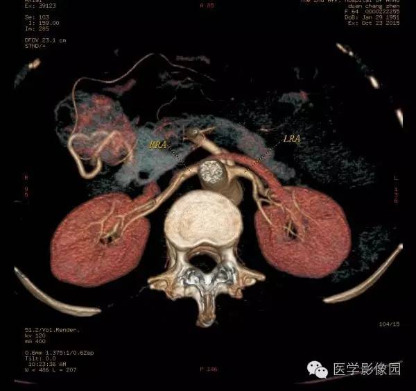 【病例】巨淋巴结增生症1例CT影像表现 【病例】巨淋巴结增生症1例CT影像表现