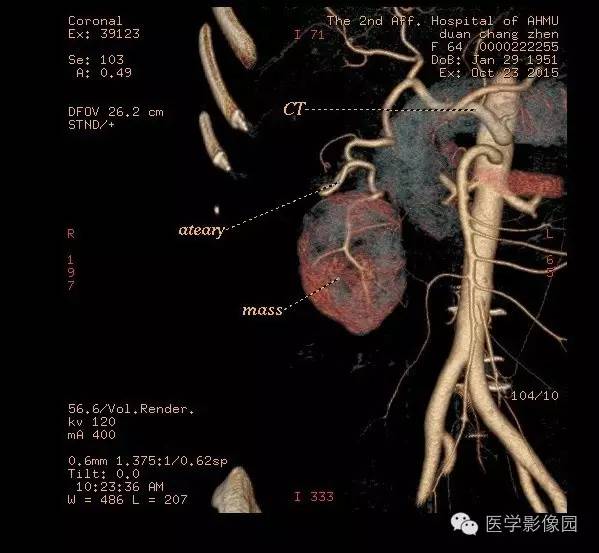 【病例】巨淋巴结增生症1例CT影像表现 【病例】巨淋巴结增生症1例CT影像表现