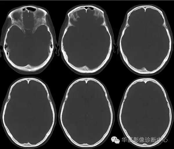 【病例】脑膜瘤1例CT——不一样的视角学习脑膜瘤 【病例】脑膜瘤1例CT——不一样的视角学习脑膜瘤