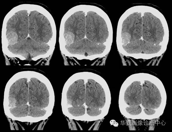 【病例】脑膜瘤1例CT——不一样的视角学习脑膜瘤 【病例】脑膜瘤1例CT——不一样的视角学习脑膜瘤