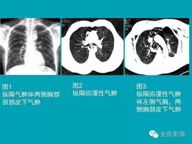 【PPT】纵隔气肿的影像学表现