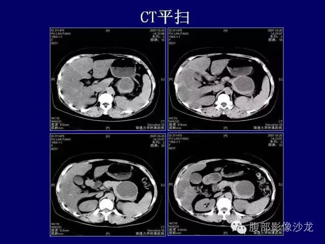 【病例】胰腺神经内分泌肿瘤1例CT及MR影像表现 【病例】胰腺神经内分泌肿瘤1例CT及MR影像表现