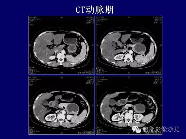 【病例】胰腺神经内分泌肿瘤1例CT及MR影像表现 【病例】胰腺神经内分泌肿瘤1例CT及MR影像表现