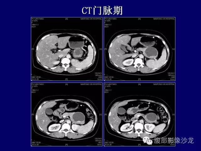 【病例】胰腺神经内分泌肿瘤1例CT及MR影像表现 【病例】胰腺神经内分泌肿瘤1例CT及MR影像表现
