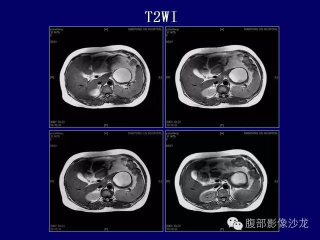 【病例】胰腺神经内分泌肿瘤1例CT及MR影像表现 【病例】胰腺神经内分泌肿瘤1例CT及MR影像表现