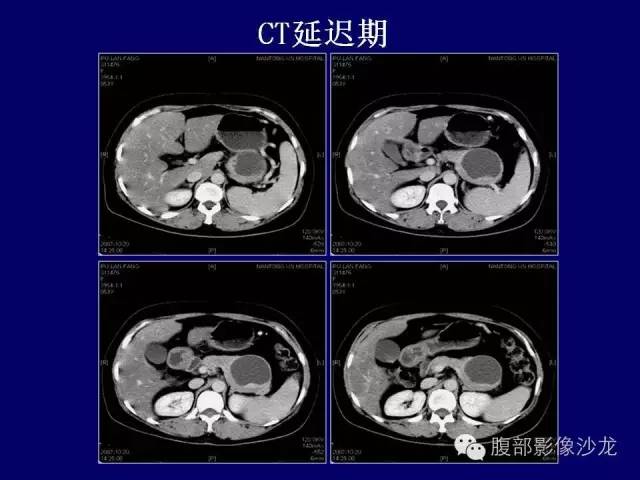 【病例】胰腺神经内分泌肿瘤1例CT及MR影像表现 【病例】胰腺神经内分泌肿瘤1例CT及MR影像表现