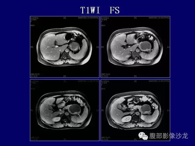 【病例】胰腺神经内分泌肿瘤1例CT及MR影像表现 【病例】胰腺神经内分泌肿瘤1例CT及MR影像表现