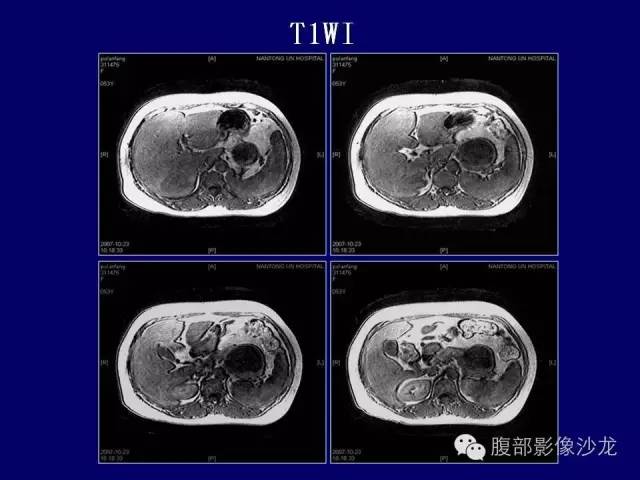 【病例】胰腺神经内分泌肿瘤1例CT及MR影像表现 【病例】胰腺神经内分泌肿瘤1例CT及MR影像表现