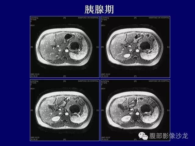 【病例】胰腺神经内分泌肿瘤1例CT及MR影像表现 【病例】胰腺神经内分泌肿瘤1例CT及MR影像表现