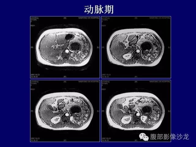 【病例】胰腺神经内分泌肿瘤1例CT及MR影像表现 【病例】胰腺神经内分泌肿瘤1例CT及MR影像表现
