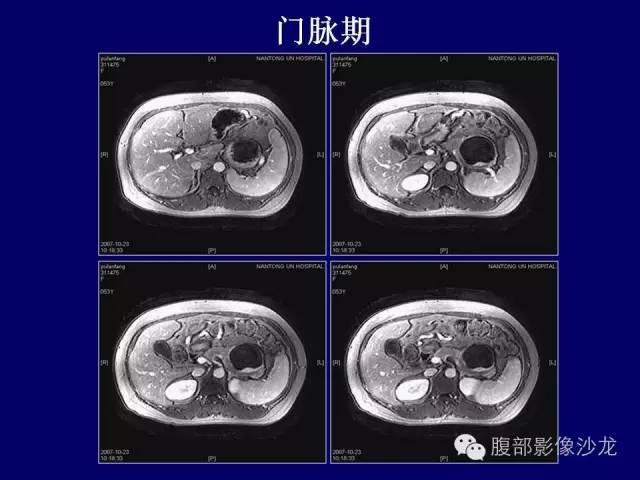 【病例】胰腺神经内分泌肿瘤1例CT及MR影像表现 【病例】胰腺神经内分泌肿瘤1例CT及MR影像表现