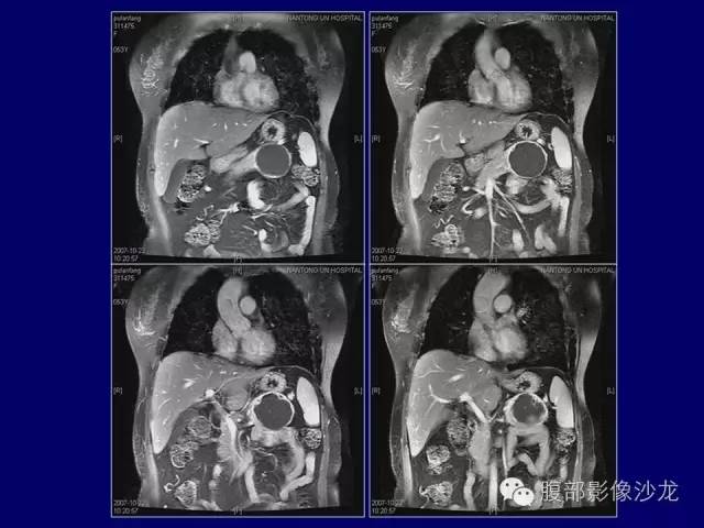 【病例】胰腺神经内分泌肿瘤1例CT及MR影像表现 【病例】胰腺神经内分泌肿瘤1例CT及MR影像表现