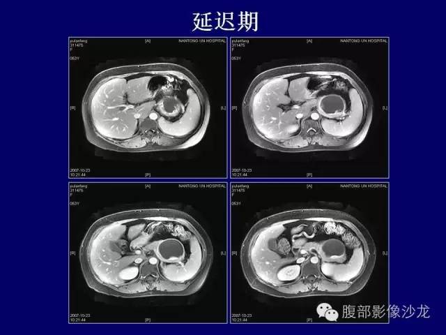 【病例】胰腺神经内分泌肿瘤1例CT及MR影像表现 【病例】胰腺神经内分泌肿瘤1例CT及MR影像表现