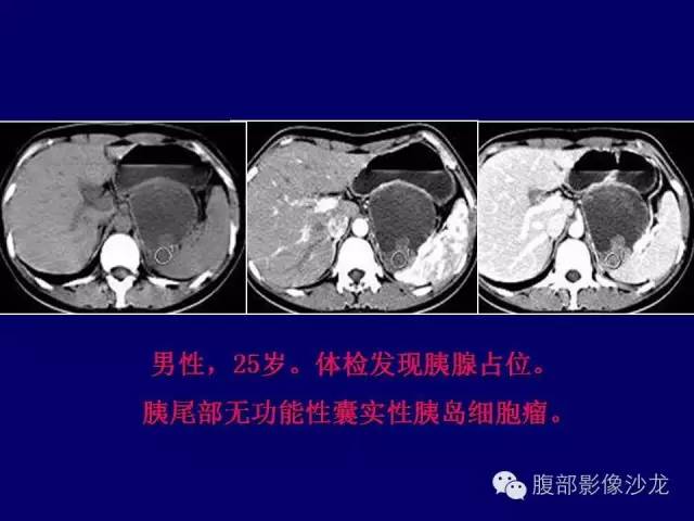 【病例】胰腺神经内分泌肿瘤1例CT及MR影像表现 【病例】胰腺神经内分泌肿瘤1例CT及MR影像表现