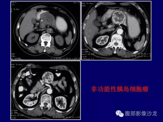 【病例】胰腺神经内分泌肿瘤1例CT及MR影像表现 【病例】胰腺神经内分泌肿瘤1例CT及MR影像表现