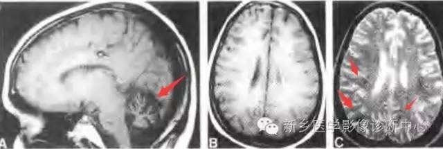共济失调性毛细血管扩张综合征