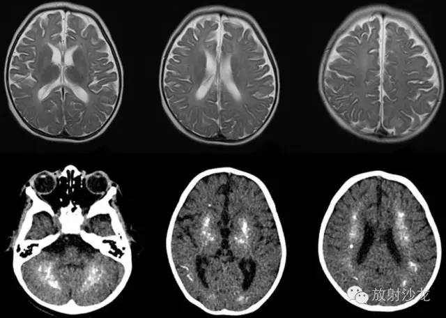 Aicardi-Goutières Syndrome（AGS）的MR表现