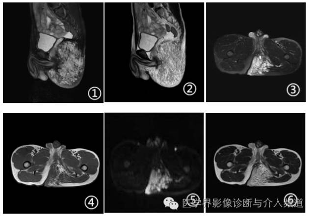 【病例】左臀部皮下神经鞘黏液瘤1例MR影像表现