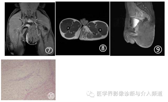 【病例】左臀部皮下神经鞘黏液瘤1例MR影像表现 【病例】左臀部皮下神经鞘黏液瘤1例MR影像表现