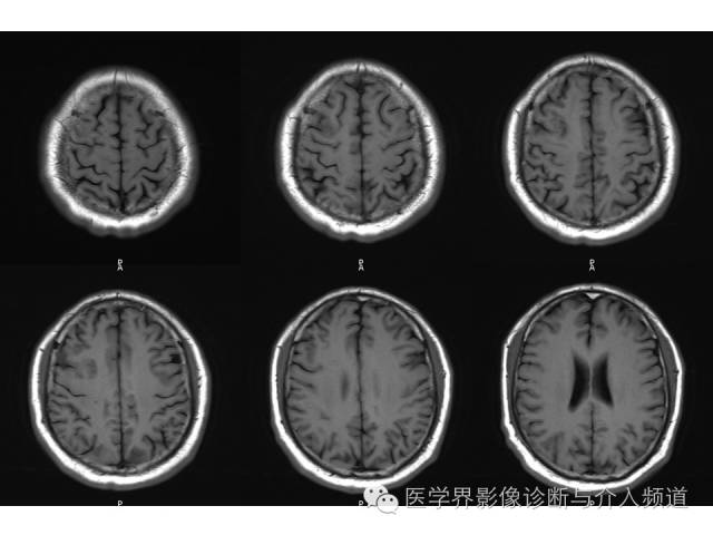 【病例】右额叶炎性肉芽肿1例MR影像表现 【病例】右额叶炎性肉芽肿1例MR影像表现