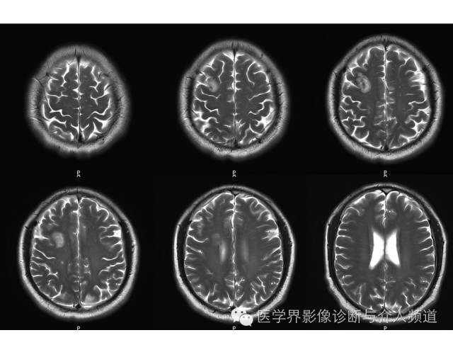 【病例】右额叶炎性肉芽肿1例MR影像表现