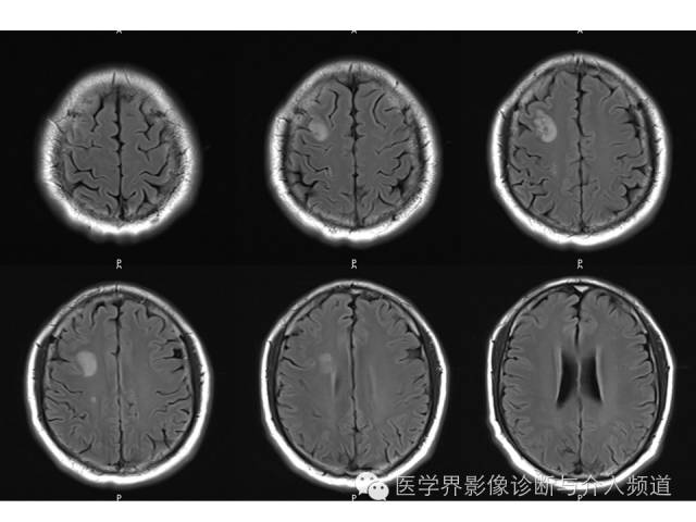 【病例】右额叶炎性肉芽肿1例MR影像表现 【病例】右额叶炎性肉芽肿1例MR影像表现