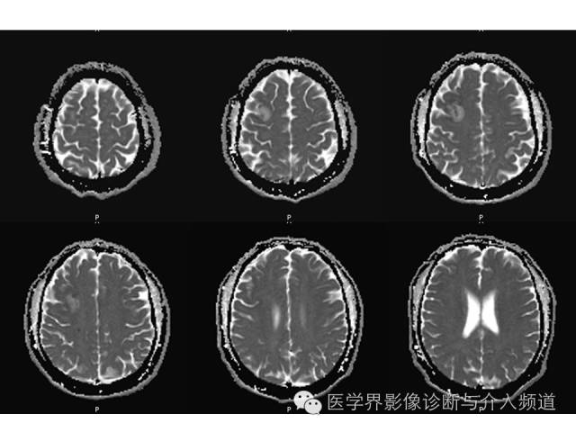 【病例】右额叶炎性肉芽肿1例MR影像表现 【病例】右额叶炎性肉芽肿1例MR影像表现