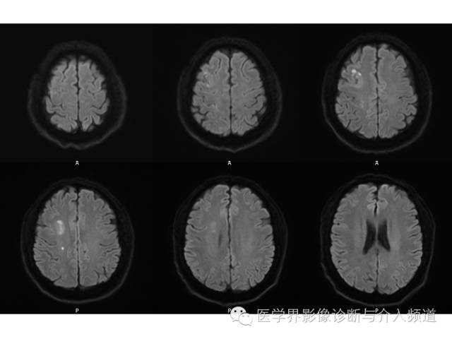 【病例】右额叶炎性肉芽肿1例MR影像表现 【病例】右额叶炎性肉芽肿1例MR影像表现