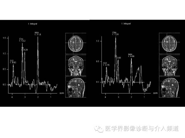 【病例】右额叶炎性肉芽肿1例MR影像表现 【病例】右额叶炎性肉芽肿1例MR影像表现