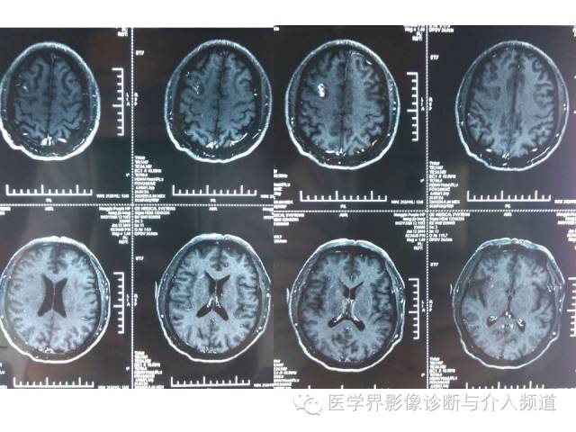 【病例】右额叶炎性肉芽肿1例MR影像表现 【病例】右额叶炎性肉芽肿1例MR影像表现