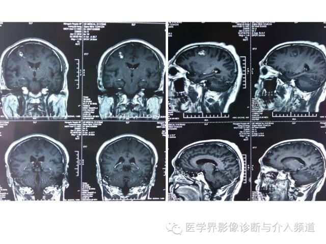 【病例】右额叶炎性肉芽肿1例MR影像表现 【病例】右额叶炎性肉芽肿1例MR影像表现