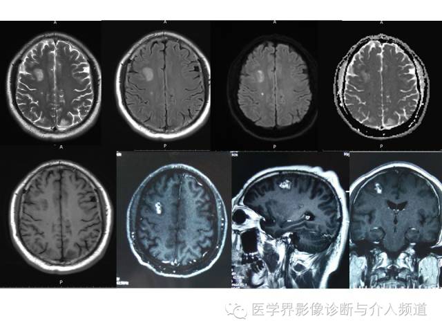 【病例】右额叶炎性肉芽肿1例MR影像表现 【病例】右额叶炎性肉芽肿1例MR影像表现
