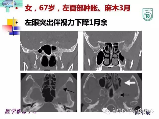 【PPT】颅底骨质破坏性病变的影像学诊断思路