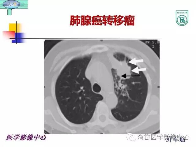 【PPT】颅底骨质破坏性病变的影像学诊断思路