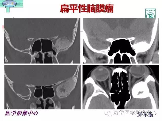 【PPT】颅底骨质破坏性病变的影像学诊断思路