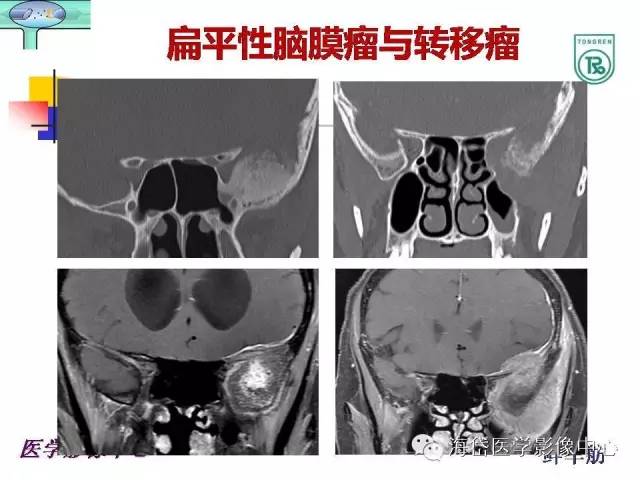 【PPT】颅底骨质破坏性病变的影像学诊断思路