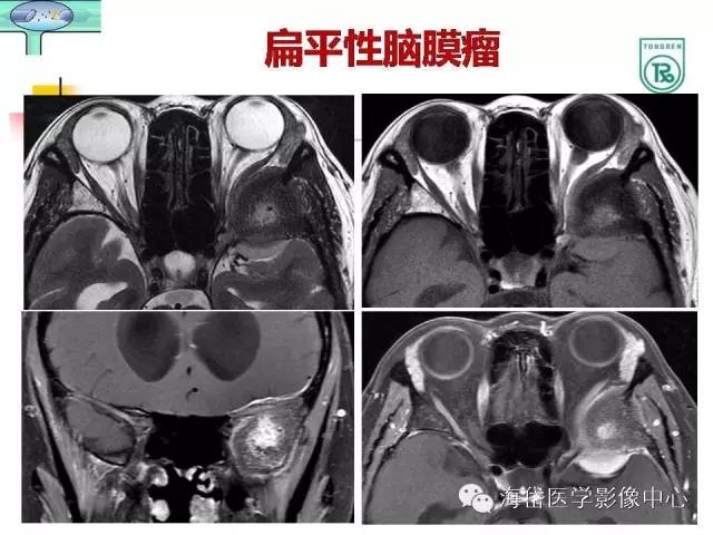 【PPT】颅底骨质破坏性病变的影像学诊断思路
