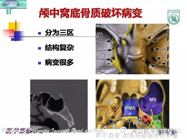 【PPT】颅底骨质破坏性病变的影像学诊断思路