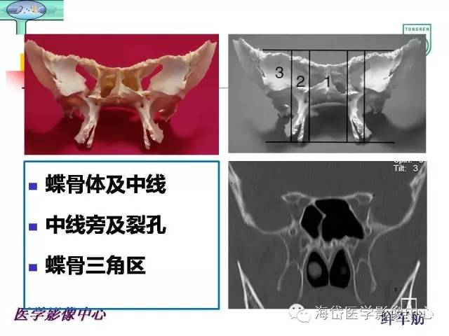 【PPT】颅底骨质破坏性病变的影像学诊断思路