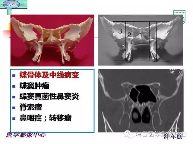 【PPT】颅底骨质破坏性病变的影像学诊断思路