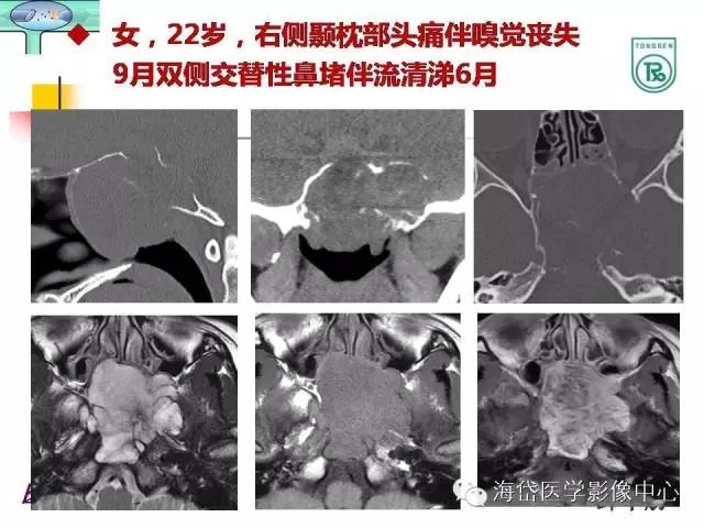 【PPT】颅底骨质破坏性病变的影像学诊断思路