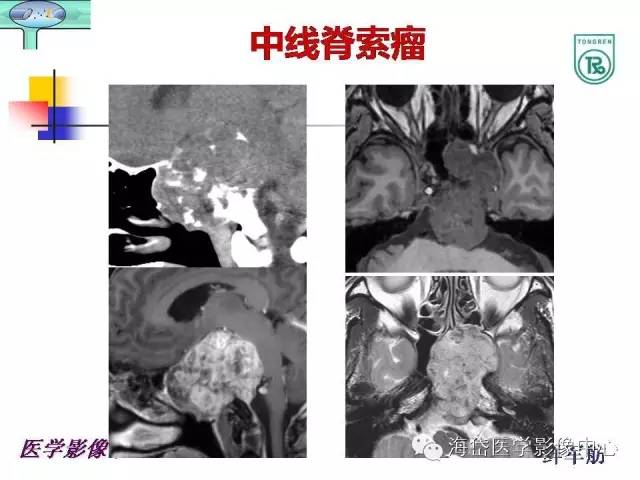 【PPT】颅底骨质破坏性病变的影像学诊断思路