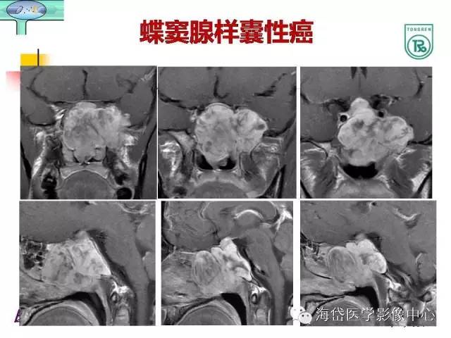 【PPT】颅底骨质破坏性病变的影像学诊断思路