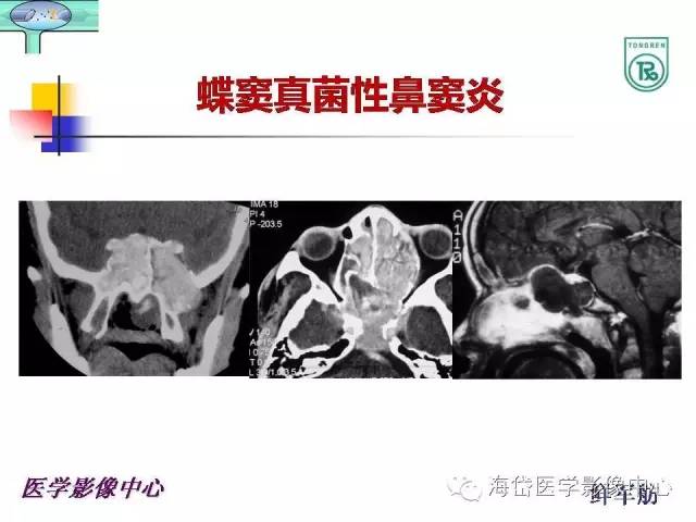 【PPT】颅底骨质破坏性病变的影像学诊断思路