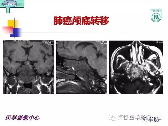 【PPT】颅底骨质破坏性病变的影像学诊断思路