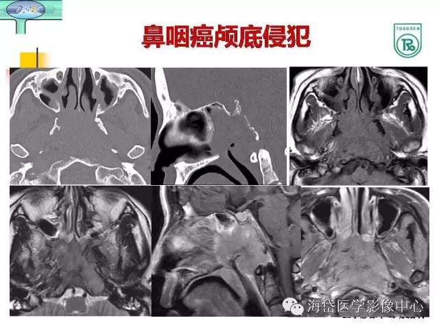 【PPT】颅底骨质破坏性病变的影像学诊断思路
