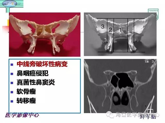 【PPT】颅底骨质破坏性病变的影像学诊断思路