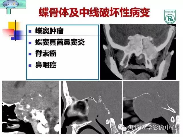 【PPT】颅底骨质破坏性病变的影像学诊断思路