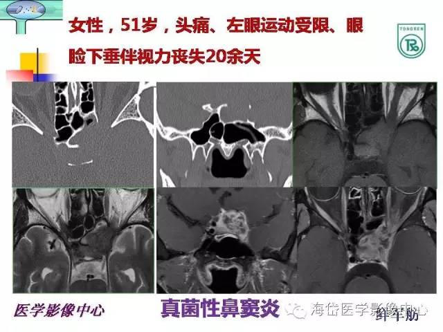 【PPT】颅底骨质破坏性病变的影像学诊断思路