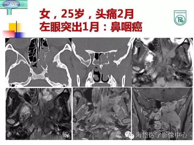 【PPT】颅底骨质破坏性病变的影像学诊断思路